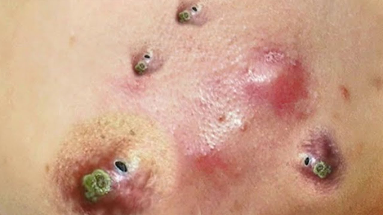 cystic acne blackhead removal