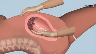How to perform Manual Removal of the Placenta