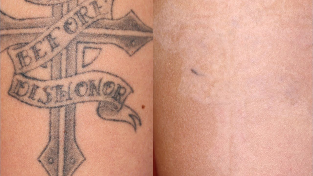 Tattoo Removal - how to make a tattoo fade - YouTube