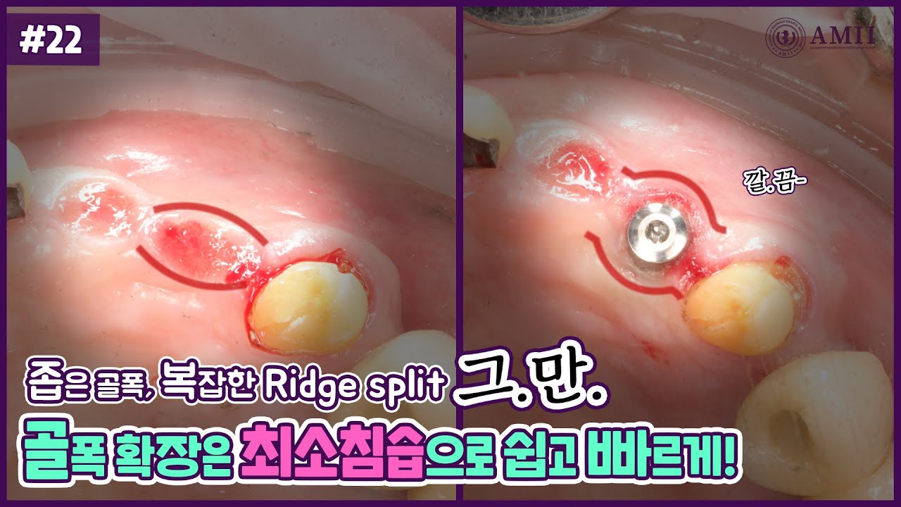 Upper Ridge Split 좁은 골폭에 Ridge split 그만! 골폭 확장은 최소침습으로 쉽고 빠르게! - YouTube