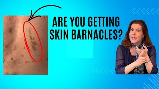 In office and DIY treatments for seborrheic keratoses -surprising tips you wish you knew years ago.