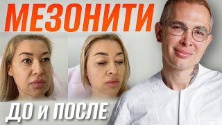 МЕЗОНИТИ ДО и ПОСЛЕ | Ставим Нити COG, мгновенная подтяжка лица #мезонити #подтяжкалица