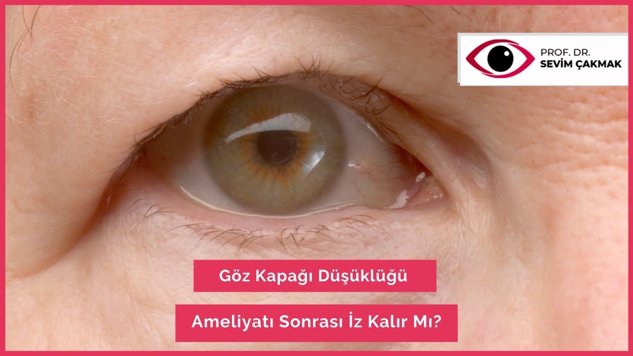 Göz Kapağı Düşüklüğü Ameliyatı Sonrası İz Kalır Mı? | Göz Kapağı