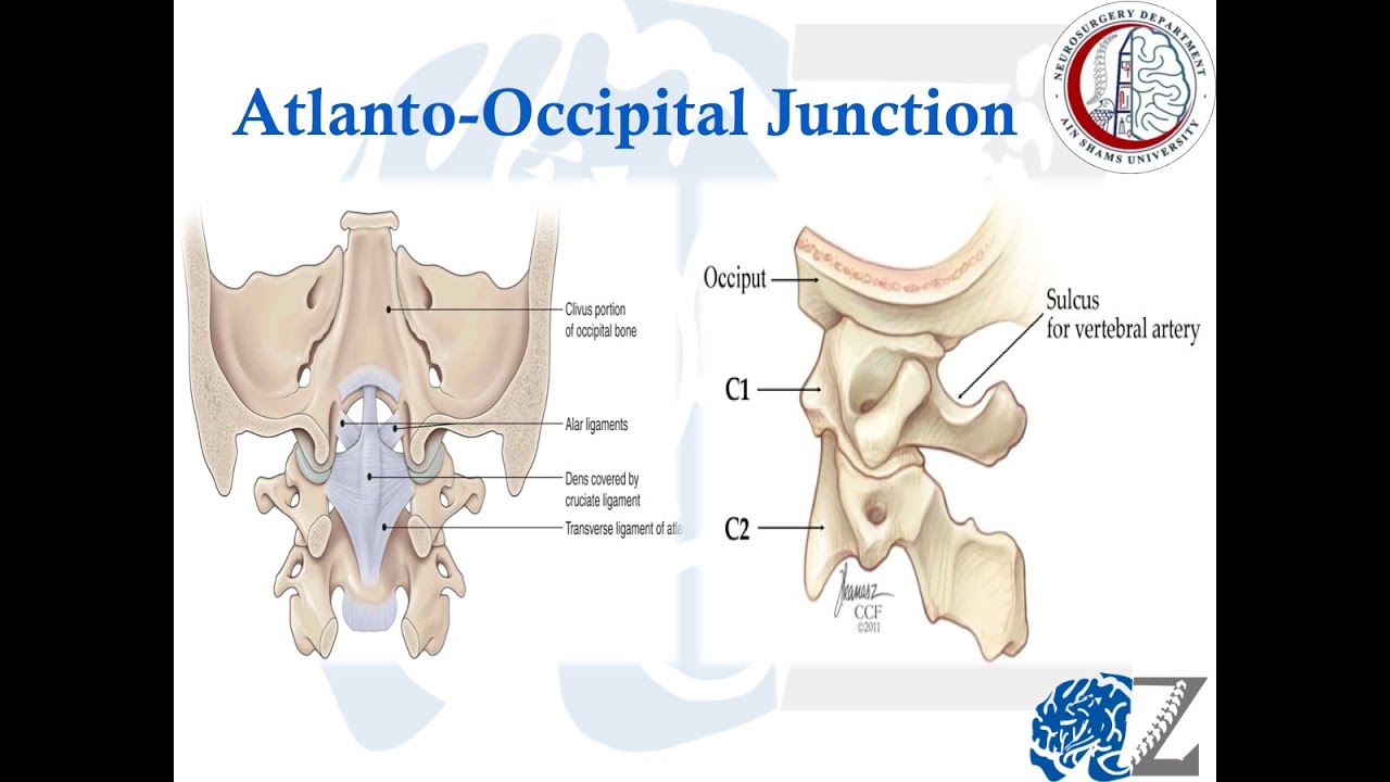 Spine Trauma (2) : Atlanto-occipital dislocation  إصابات العمود الفقري