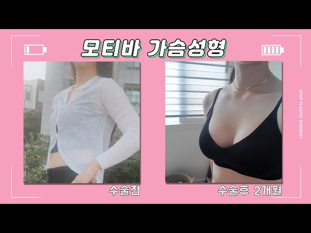 모티바가슴성형,  꽉찬 B컵 느낌?! 삶의 질이 달라지는 가슴성형 리얼 셀카 후기//에이탑성형외과/ATOP plastic surgery/韩国爱她整形外科医院