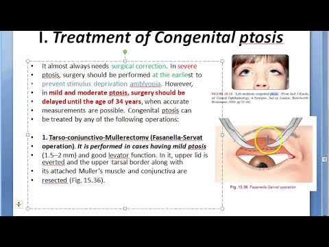 Oftalmologi 388 d Ptosis Behandling Fasanella-Servat Frontalis slynge øjenkirurgi øjenlåg hængende