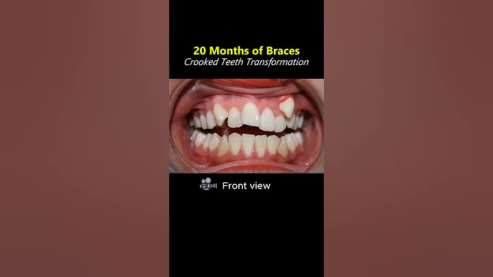 Amazing 20 months braces result for crooked teeth #braces #orthodontist #dentist #teeth
