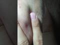 Beard hair #massage therapy #ingrownhair #relax #hairgrowth #skincare #shorts #video #viral