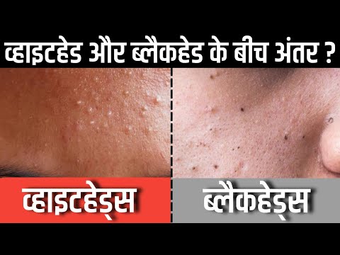 व्हाइटहेड्स और ब्लैकहेड्स के बीच अंतर ? Difference between Whiteheads & Blackheads ?