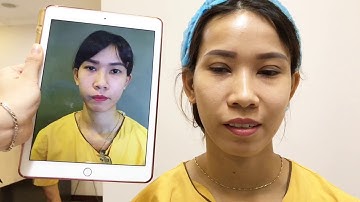 Tạo Mắt 2 Mí Bằng Công Nghệ Cắt Mí Mani Mini Deep 5D