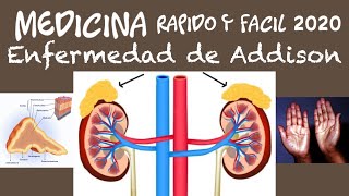 Enfermedad de Addison (Rápido y fácil)