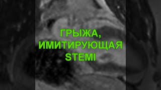 Грыжа пищеводного отверстия диафрагмы, имитирующая инфаркт миокарда с подъемом ST