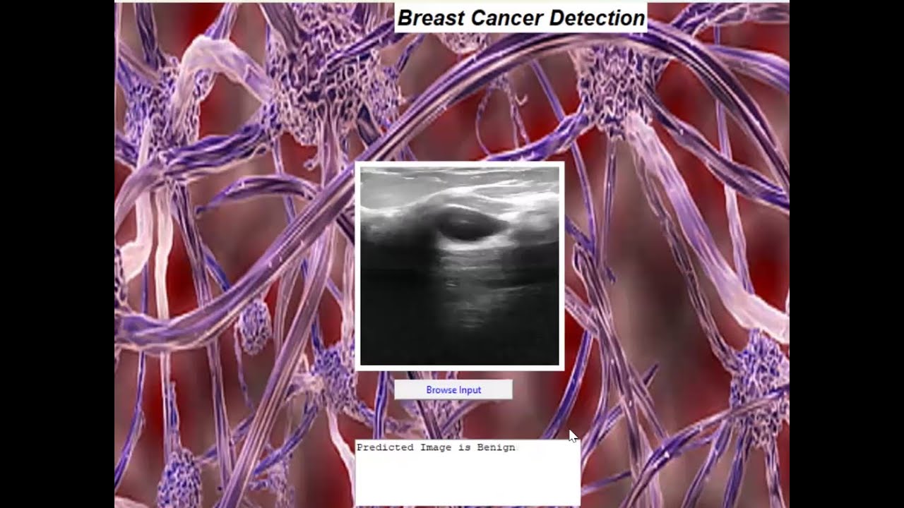Breast cancer detection and classification using convolution neural ...