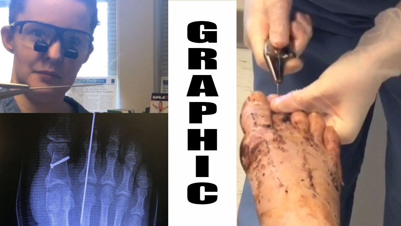 Pin Pulled From Toe After Bunion Surgery YouTube