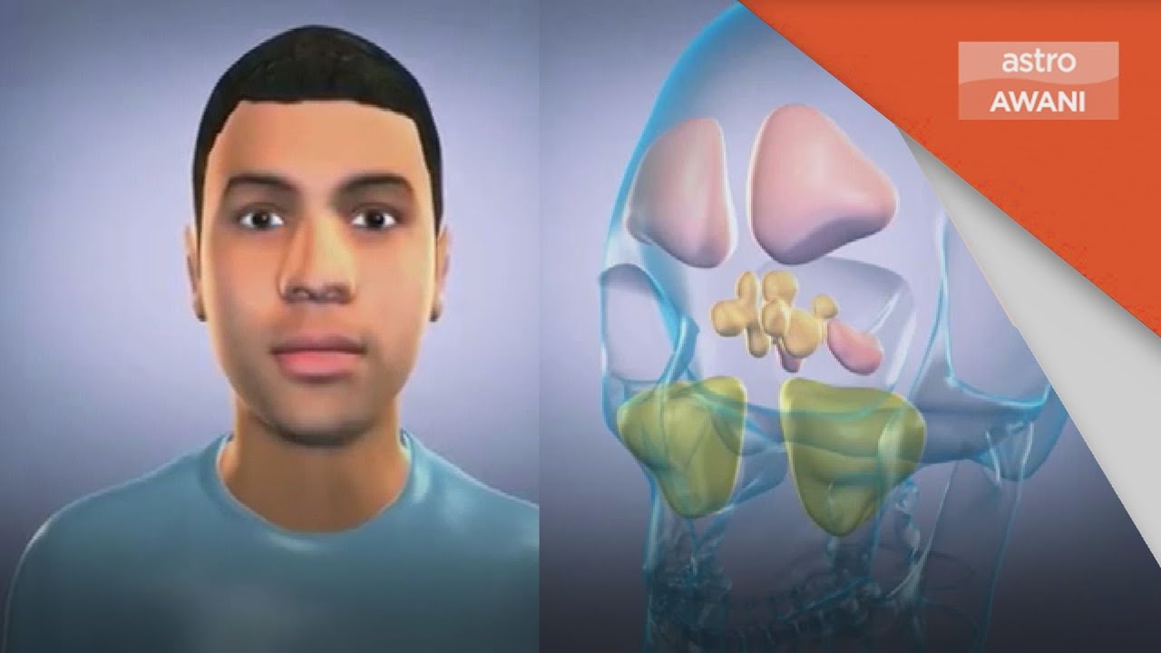 Kesihatan | Resdung penyebab sakit kepala