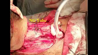 Total Layrngectomy by Dr.Nurul Huda Nayeem
