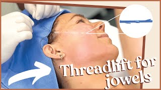 PDO THREAD FACELIFT TO FIX JOWL AND FACIAL ASYMMETRY