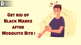 MOSQUITO BITE MARKS | How to treat black marks after mosquito bite?-Dr. Nischal K  | Doctors' Circle