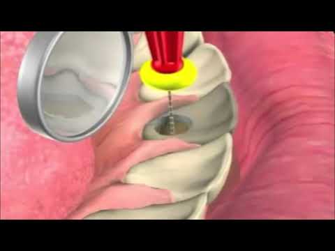 Waikato Endodontics: Internal Bleaching