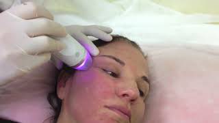 Gold micro needle rf facial machine