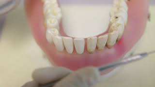 [Periodontal Examination Series] 11. Tooth Mobility (Miller Classification 1950)