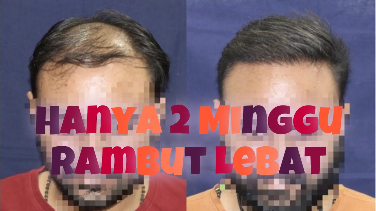 Penumbuh Rambut Cepat 2 Minggu (bukan minoxidil)