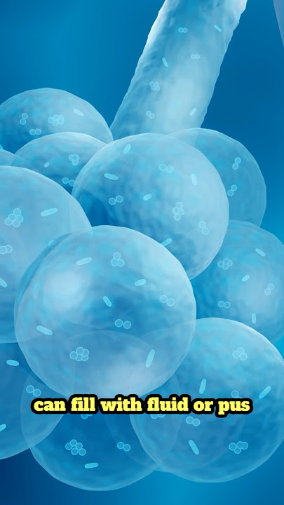 What is pneumonia? Explained in 60 seconds! #pneumonia #lungs #breathing