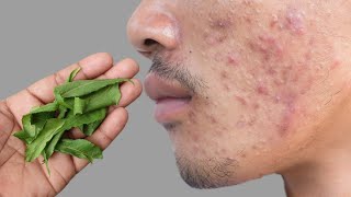 सिर्फ 3 बार में पिंपल,फोड़े,फुंसी हमेशा के लिए ख़त्म | Pimples Treatment