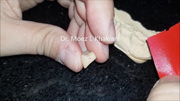 Checking proximal contacts on prosthesis using 12 micron Arti-fol from Bausch