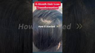 6-Month Major Female Hair Loss Transformation Without Minoxidil #DrHopkirk #HRP™️ #hairlosstreatment