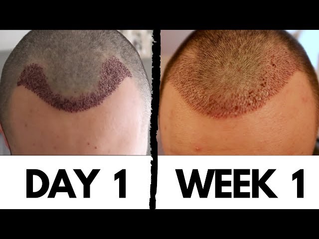 Before and after hair transplant Step-by-Step Situation - Desmoderm