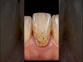 Clean the heavy plaque teeth 🦷 #teeth #teethwhitening #teethcleaning