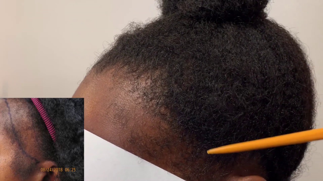 African American Women Gets Hair Transplant For Her Traction Alopecia Results After One Year african-american-women-gets-hair-transplant-for-her-traction-alopecia-results-after-one-year