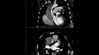 Stanford type-A aortic dissection with such entry point