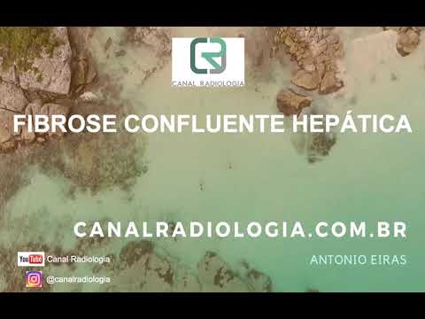 Vídeo: Hepatite C E Fibrose: Compreendendo Sua Pontuação De Fibrose