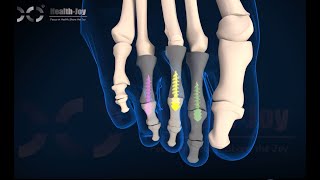 Cheveron Osteotomy,Scarf Osteotomy, Weil Osteotomy, Hammertoe Correction
