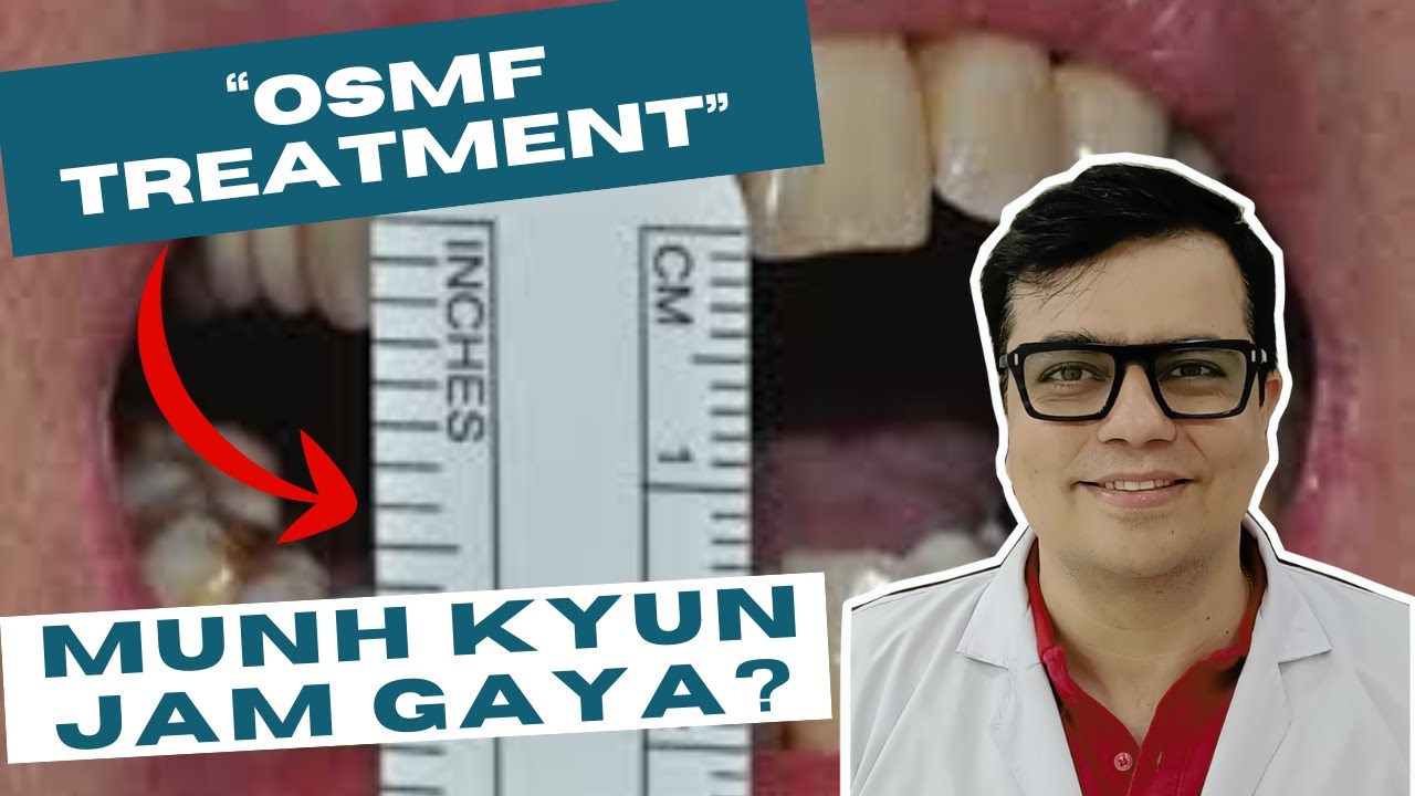 OSMF Complete Treatment Guide | Munh Kyun Jam Jata Hai? Symptoms, Exercises & Surgery