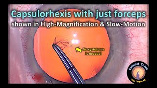 Capsulorhexis with just forceps to improve cataract surgery