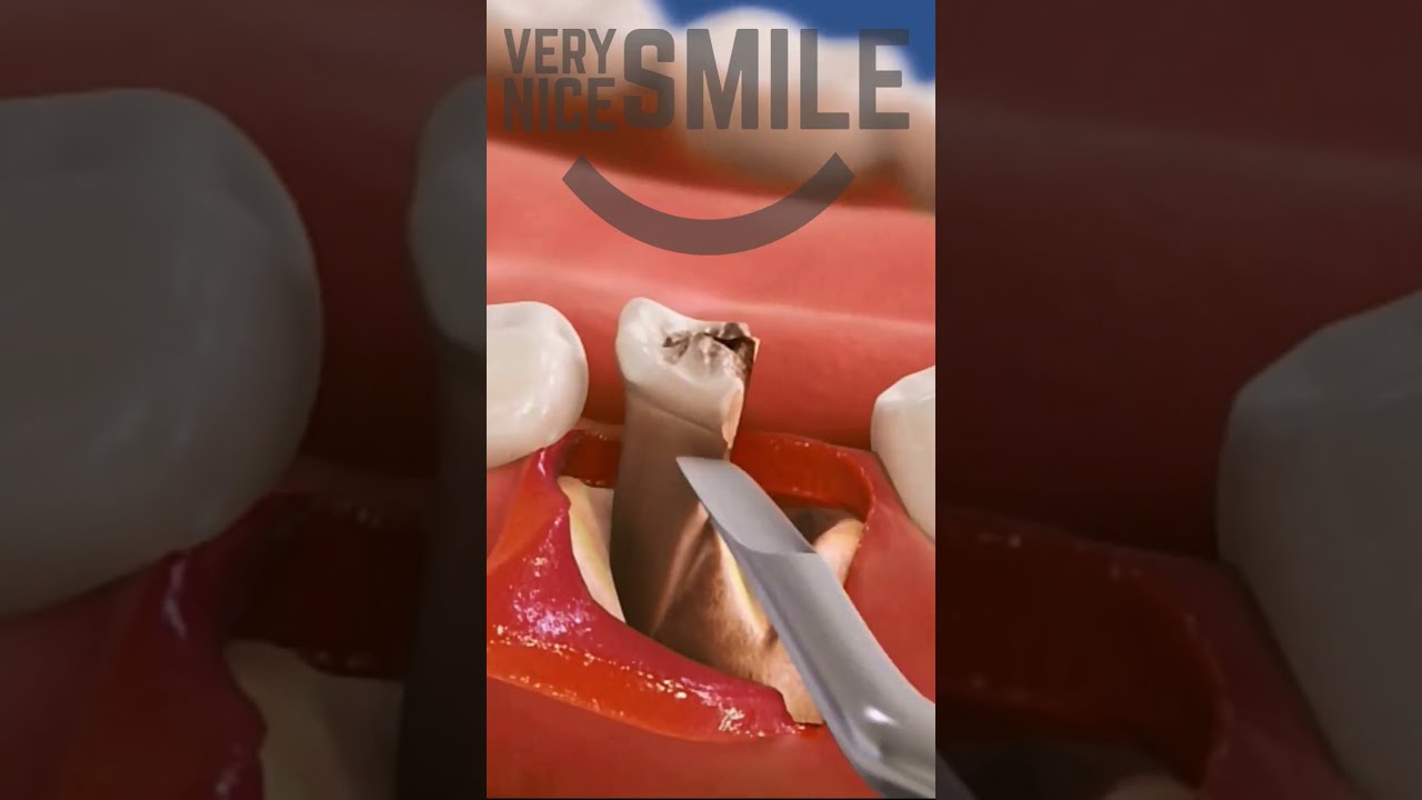 Surgical Extraction and Bone Graft