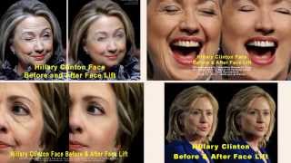 Hillary Clinton Face Before and After Face Lift #481 e