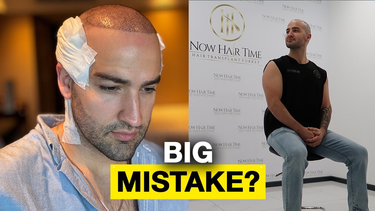 The Red Flag I Ignored During My Hair Transplant in Turkey | NowHairTime Review