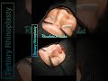 #TertiaryRhinoplasty #revisionrhinoplasty #secondaryrhinoplasty #drsaadatullah #islamabad #rawalpind