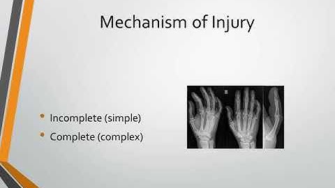 MCP Joint Dislocation