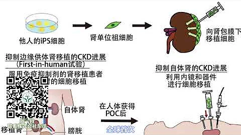 日本利用iPS細胞挑戰腎臟再生，減少人工透析患者！日本開發了移植可以保護腎臟的腎祖細胞的細胞療法，並計劃推進實用化，這一醫學成果將改變世界。 - 天天要聞