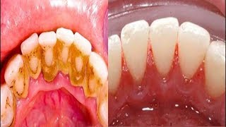 Solución RAPIDA y EFECTIVA para el SARRO EN LOS DIENTES