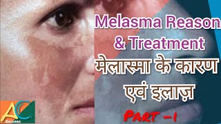 Melasma Reason and Treatment || मेलास्मा कारण और सही इलाज़