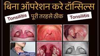 TONSILITIS | बिना ऑपरेशन करे टॉन्सिल्स पूरी तरहसे ठीक | Tonsils enlargement Inflammation