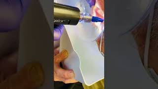 Ear Wax Removal using the Earigator.  We’re at it again on Waxy Wednesdays!