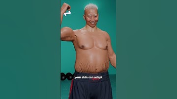 How Stretch Marks Happen