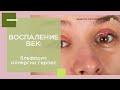 ВОСПАЛЕНИЕ ВЕК: опухоль, аллергия, ячмень, блефариты, герпес